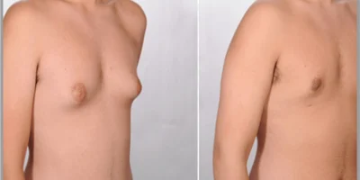 reduces puffy nipples